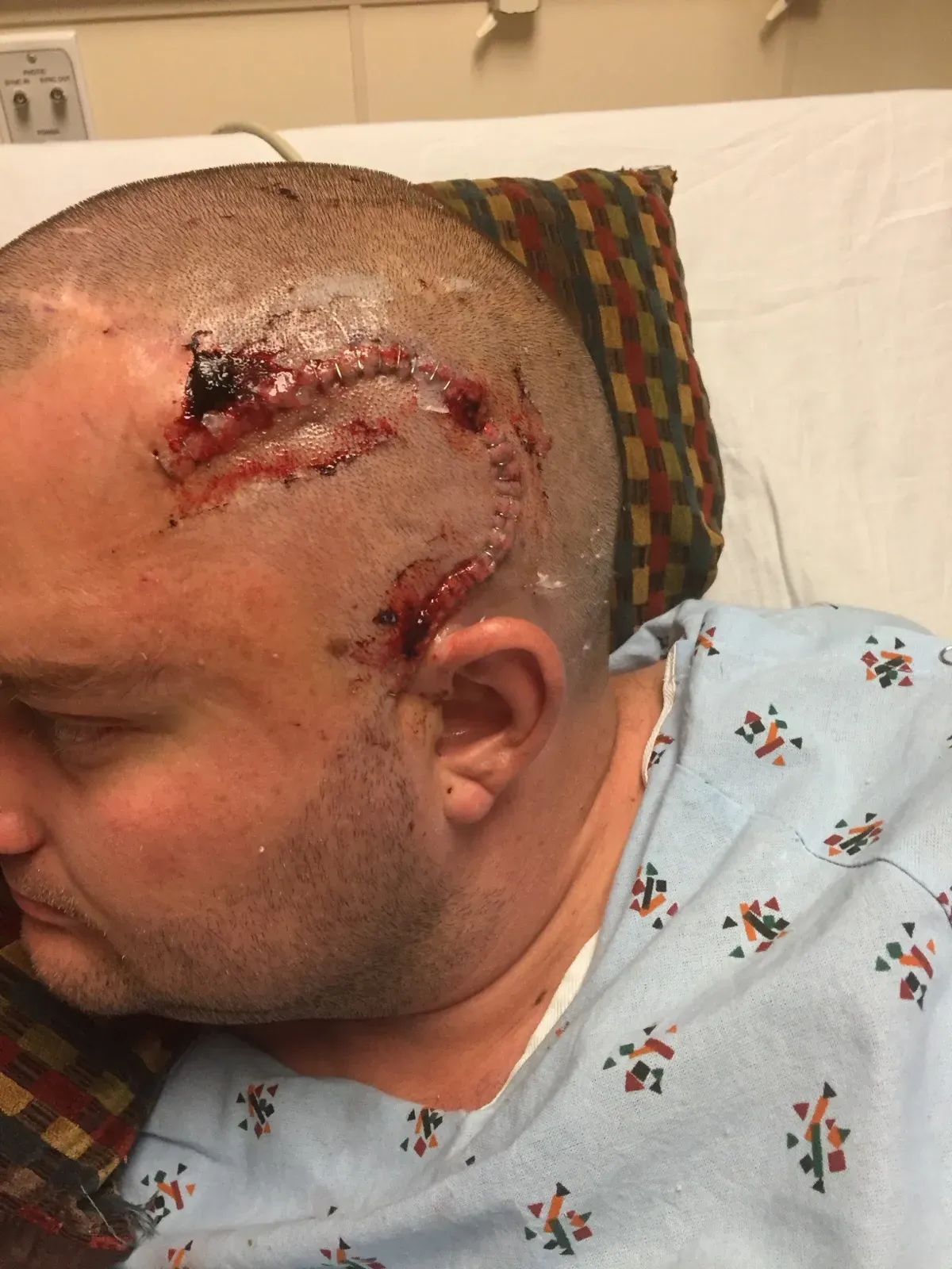 Fresh stapled incision in the hospital, right after left anterior temporal lobectomy surgery in 2017