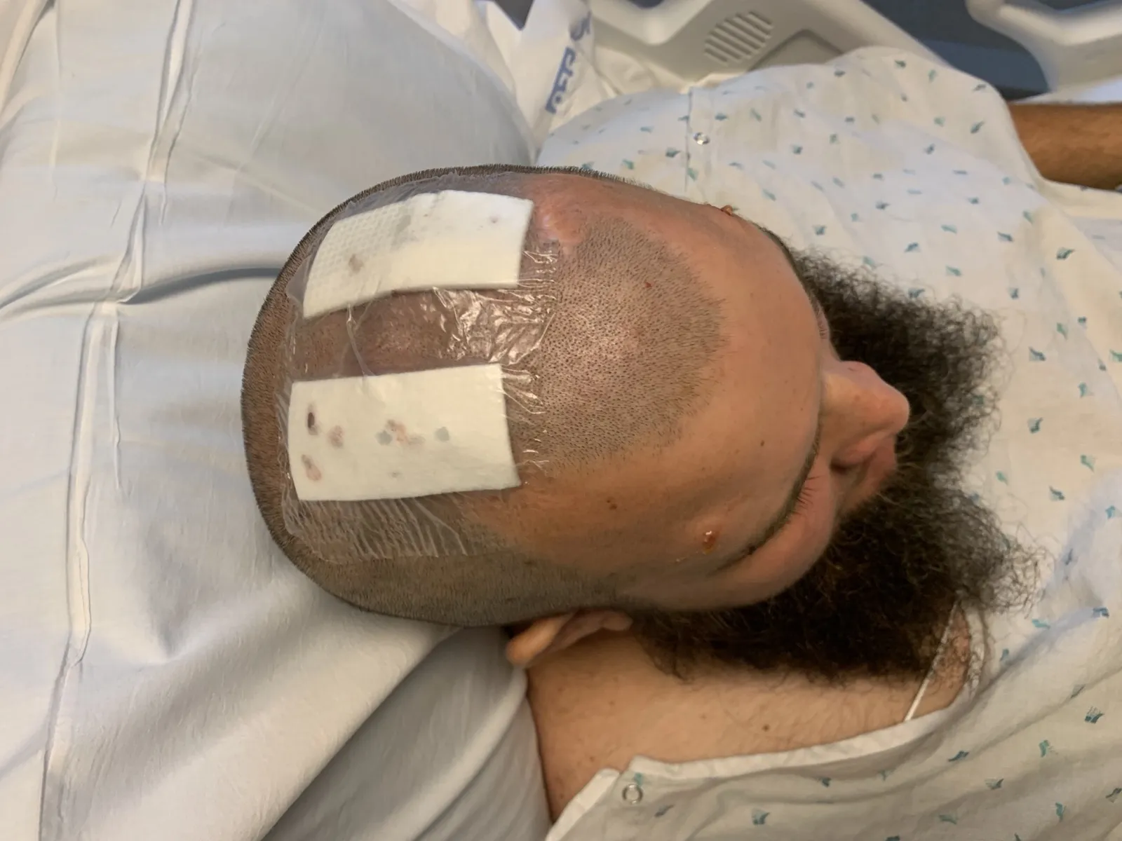 Bandaged lead entry sites on the scalp, right after deep brain stimulation surgery in 2022