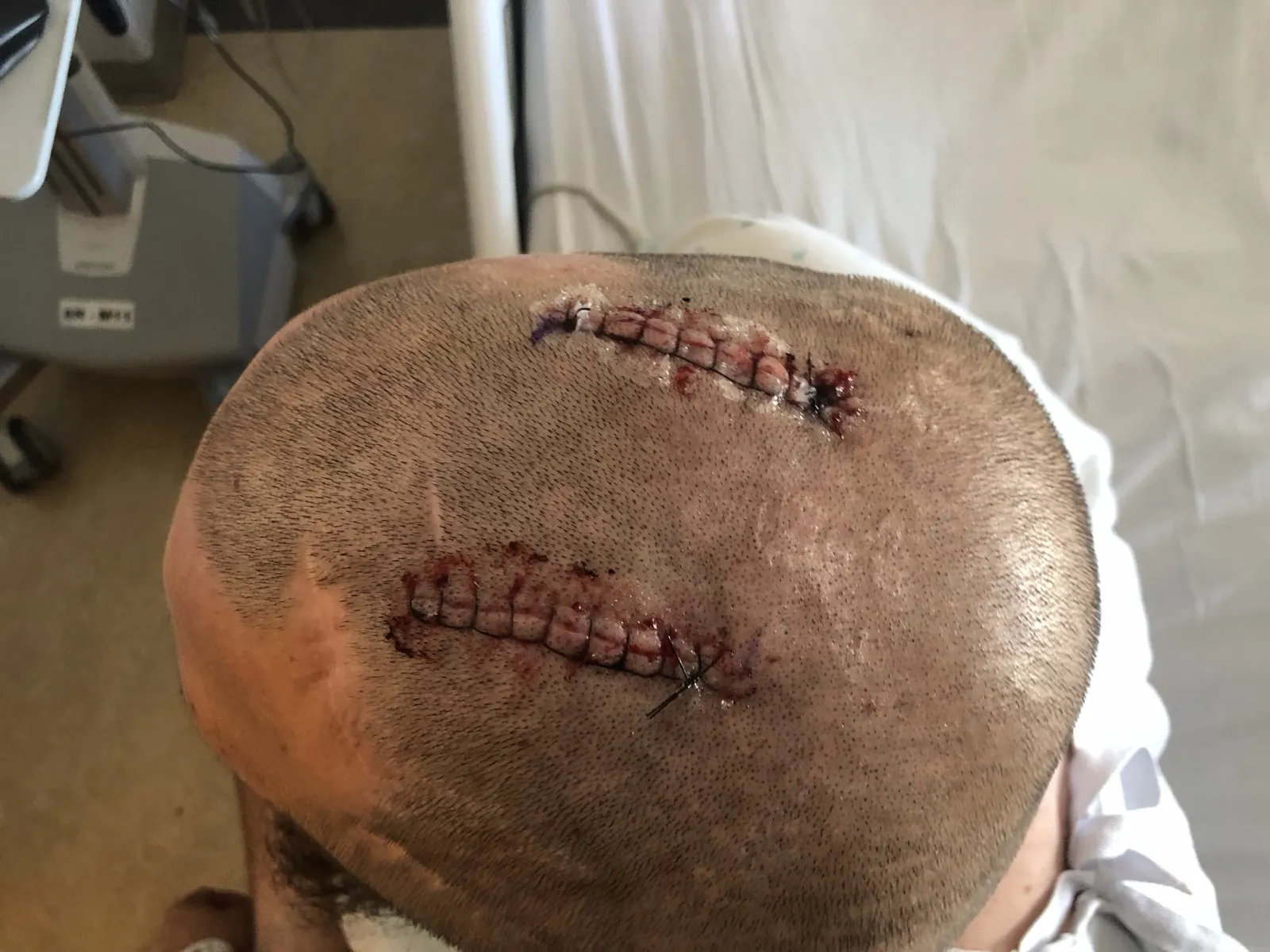 Close-up of the two stapled incisions on top of the head after deep brain stimulation surgery in 2022